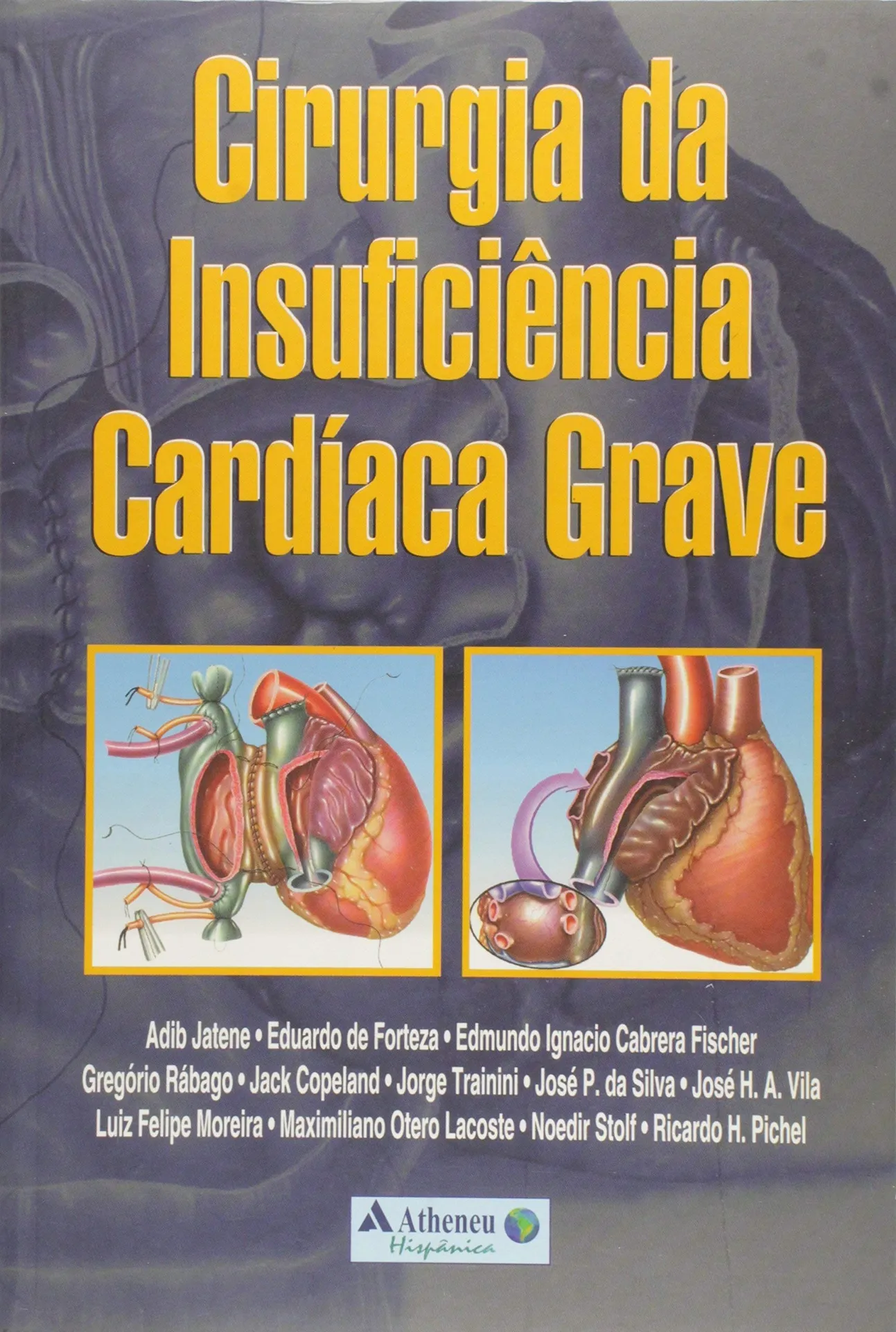 Cirurgia da insuficiência cardíaca grave Cirurgia da insuficiência cardíaca grave