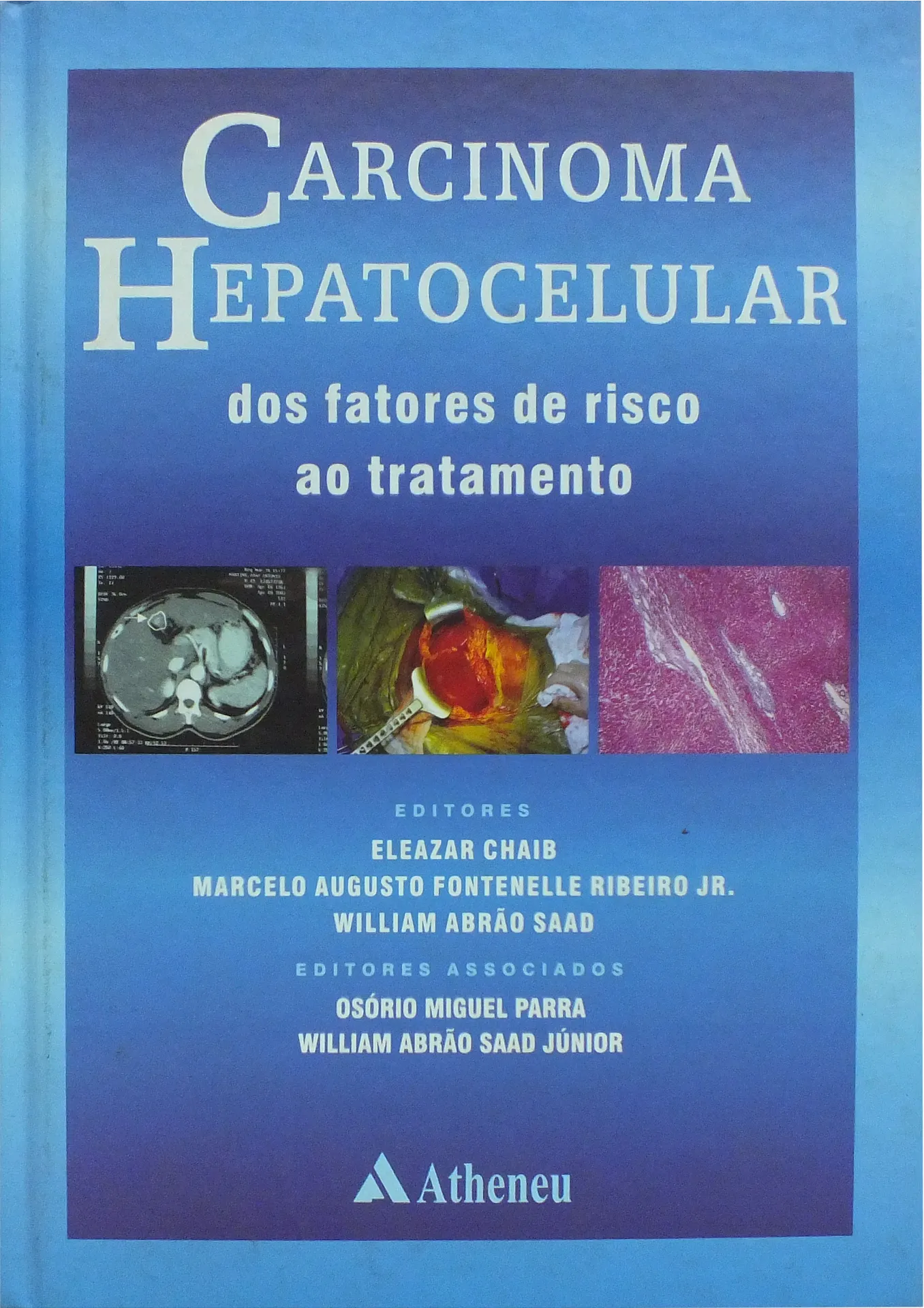 Carcinoma hepatocelular Carcinoma hepatocelular